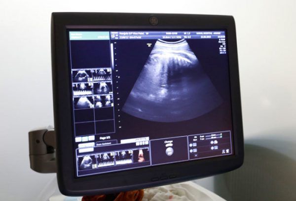 Kentucky Senate Passes Bill Banning Abortion when Baby’s Heartbeat First Detected