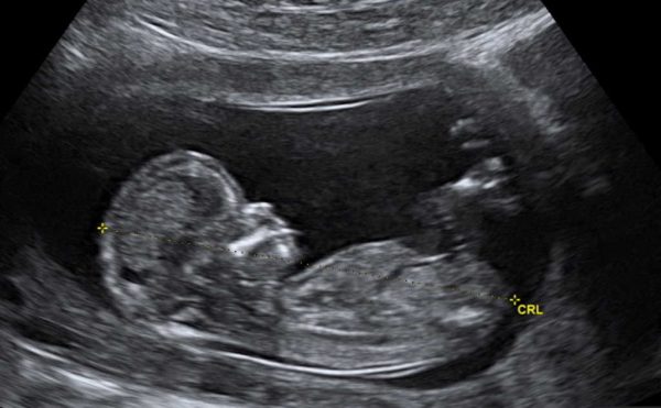 ‘A Historic Day’: Pro-Lifers Rejoice After Court Upholds Kentucky’s Landmark Ultrasound Law
