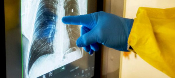 Risk of Tuberculosis Rises After COVID – What Does It Mean? Phthisiatrician Anna Belozerova Explains